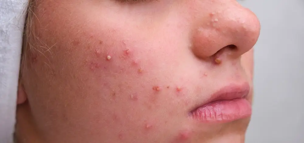 What is Narrow Spectrum Antibiotics